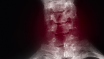 Cervical myelopathy and radiculopathy - What and when are the surgical options