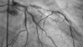 Calcium scoring and CT coronary angiography