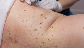 Age group‐specific changes in keratinocyte cancer treatment rates in Australia, 2012–2021