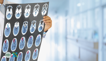 Atrial Fibrillation and the Brain- Strokes, Bleeds and Dementia