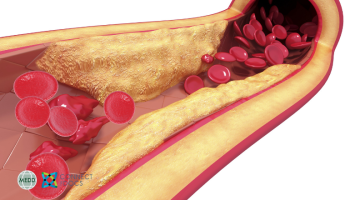 Coronary Artery Disease