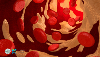 New Era of LDL-C Lowering: Evolving therapies, evolving evidence, evolving guidance