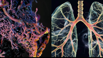 What's new therapeutically for small cell lung cancer