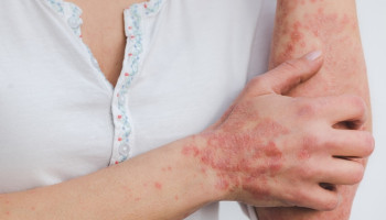 Prices and clinical benefits of biologic therapies for plaque psoriasis