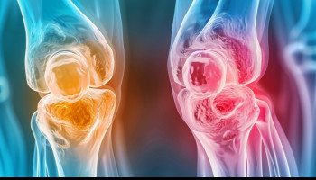 Clinical Update on the Management of Psoriasis and Psoriatic Arthritis: The Role of Bimekizumab