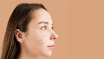 Compare and contrast between the 2016 and the latest 2024 JAAD guidelines in acne vulgaris