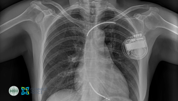 Advances in pacemakers