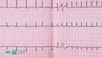 Atrial Fibrillation in 2024