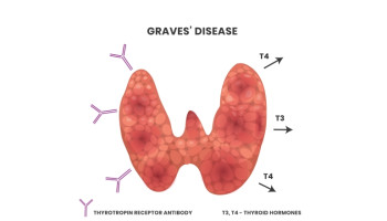 Approach to the patient considering long-term antithyroid drug therapy for Graves' disease