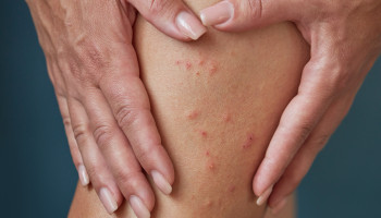 Scabies: a clinical update