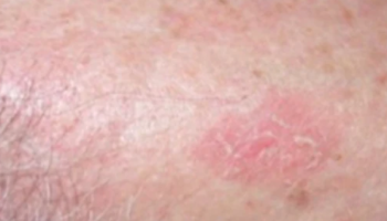 An approach to non-pigmented skin lesions