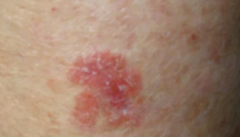 Topical treatment and medico-legal issues for skin cancer medicine