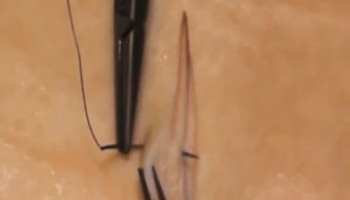 Excision and repair for skin cancer medicine