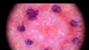 Suturing and Perfecting the Ellipse