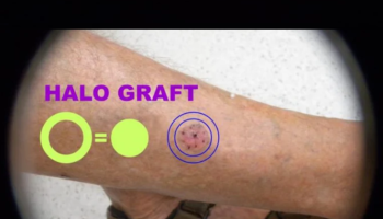 Biopsy, Haemostasis and Halo grafting for skin cancer medicine