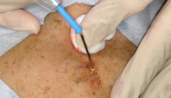 Currettage and Cautery for skin cancer medicine