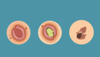 The Big Three: BCC, SCC and Melanoma