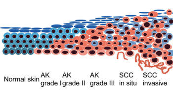 Field treatments for skin cancer medicine