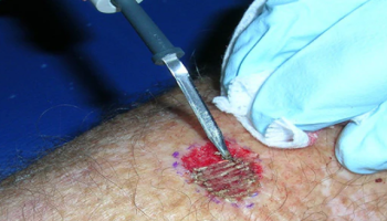 Cryosurgery and electrosurgery in skin cancer medicine