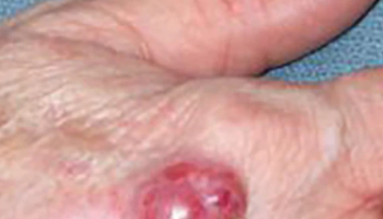 Merkel cell carcinoma and rare/aggressive melanoma and non-melanoma skin cancers
