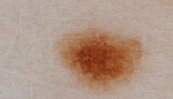 Dermoscopy for melanocytic nevi