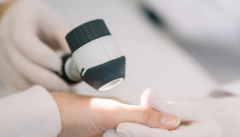 Dermoscopy for acral lesions