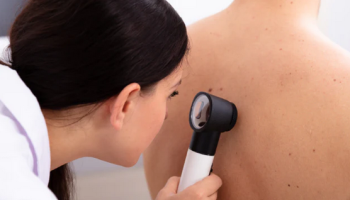 Dermoscopy for melanoma