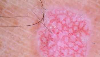 Dermoscopy for pink lesions