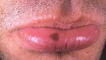 Dermoscopy for mucosal lesions