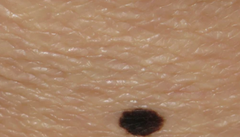 Dermoscopy for difficult benign lesions including nevi with special features