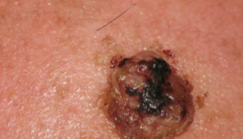 Dermoscopy for rare skin tumours