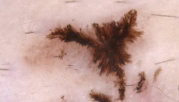 The broad spectrum of BCC and keratinocyte skin cancer