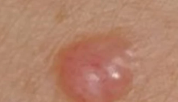Dermoscopy for difficult melanomas