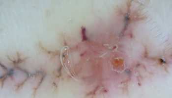 Dermoscopy in general dermatology