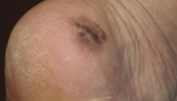 Types of lesions - Flat/nodular, pigmented/non-pigmented