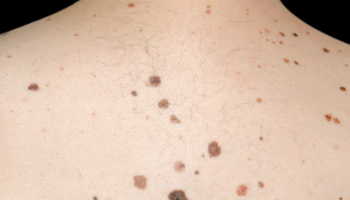 Management of patients with multiple moles