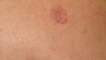 Dermoscopy for the management of non-melanoma skin cancer (NMSC)