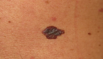 Management rules to detect melanoma