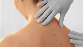 Theory, Anatomy and Principles of Skin Cancer Surgery