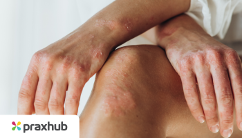 Topical Corticosteroids and Dermatoses