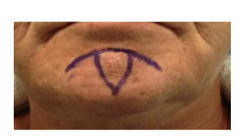 Tips and Tricks for Skin Cancer Surgery