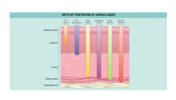 Lasers: Vascular conditions