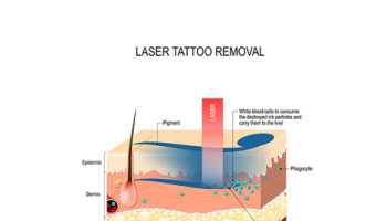 Lasers: Tattoo and Hair Removal