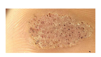 Common benign lesions, pigmentary conditions and cutaneous infections