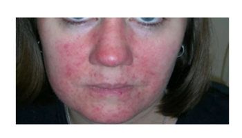 Facial rashes, Systematic diseases and Fungal infections