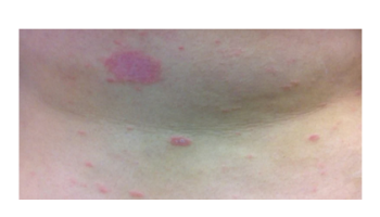 Papulosquamous disorders: Psoriasis, lichen planus and pityriasis rosea
