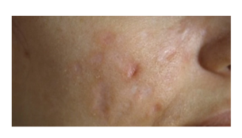 Atopic dermatitis and Acne 1