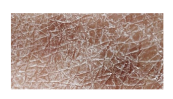 Dermatopathology, Pruritus and Contact Dermatitis