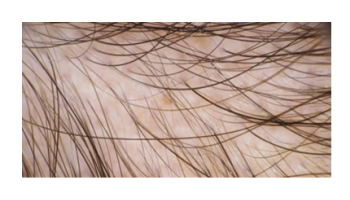 Nail disorders and Hair loss