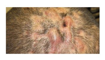 Paediatric topics, Follicular disorders and Blistering disorders